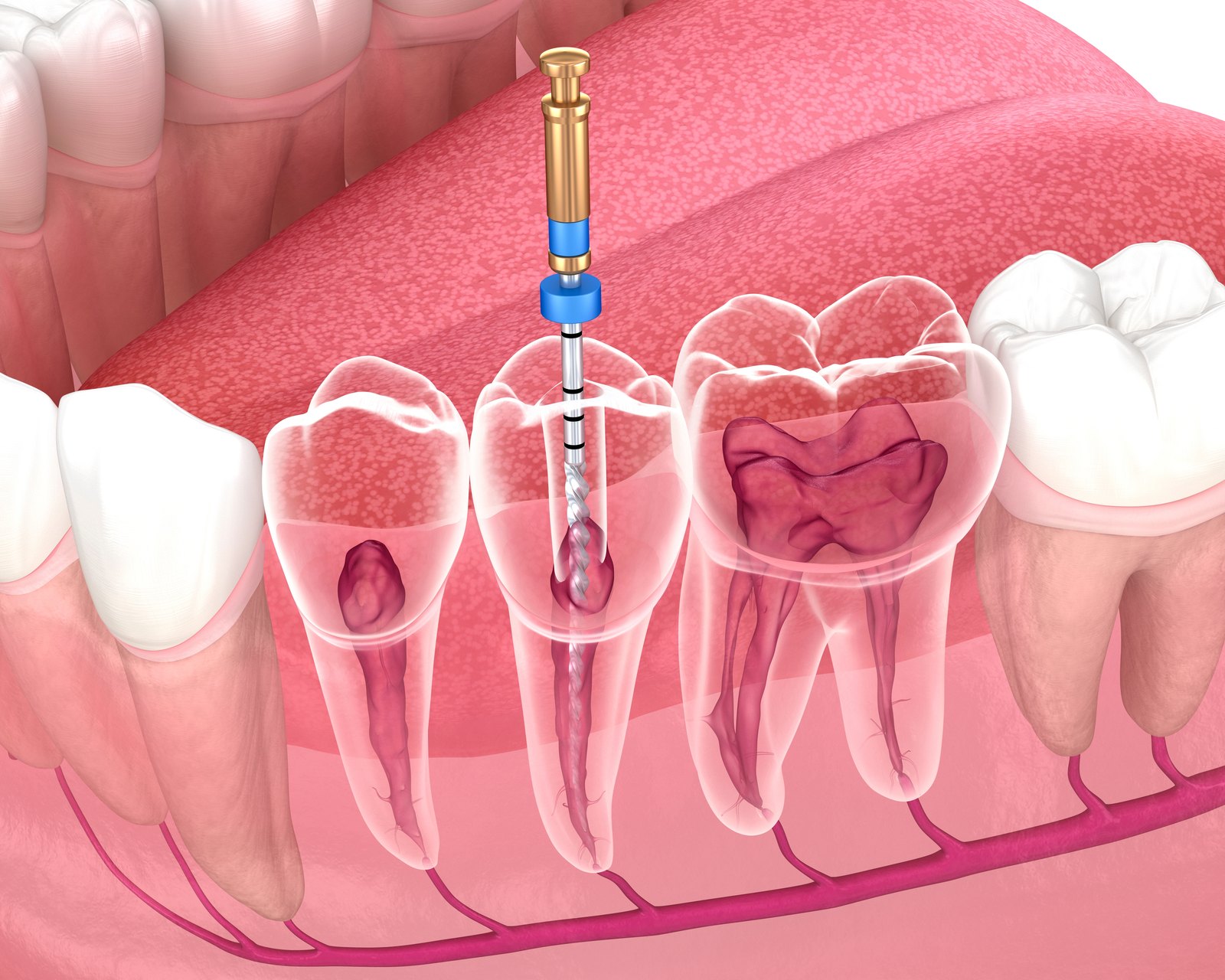 신경치료 과정 (Endodontic Treatment)