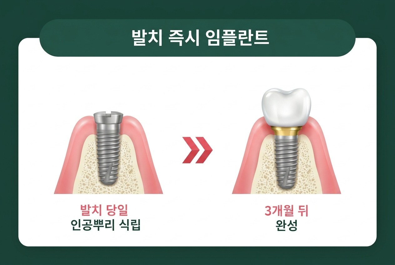 발치 즉시 임플란트 — 발치 당일 인공뿌리 식립, 3개월 뒤 완성